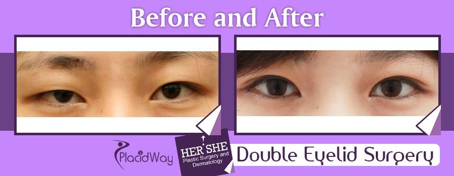 Before and After Pictures Double Eyelid Surgery in Seoul, South Korea